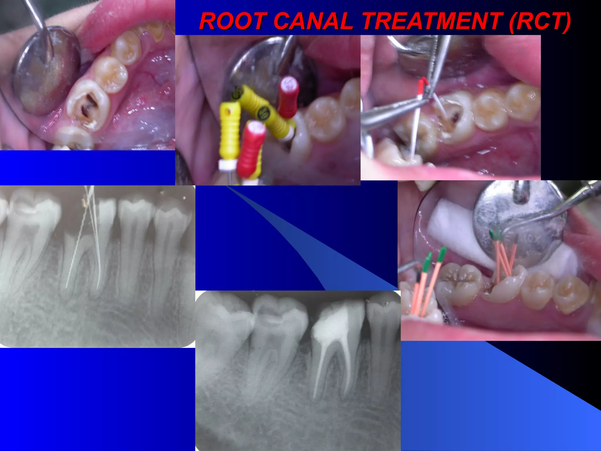 ROOT CANAL TREATMENT (RCT)