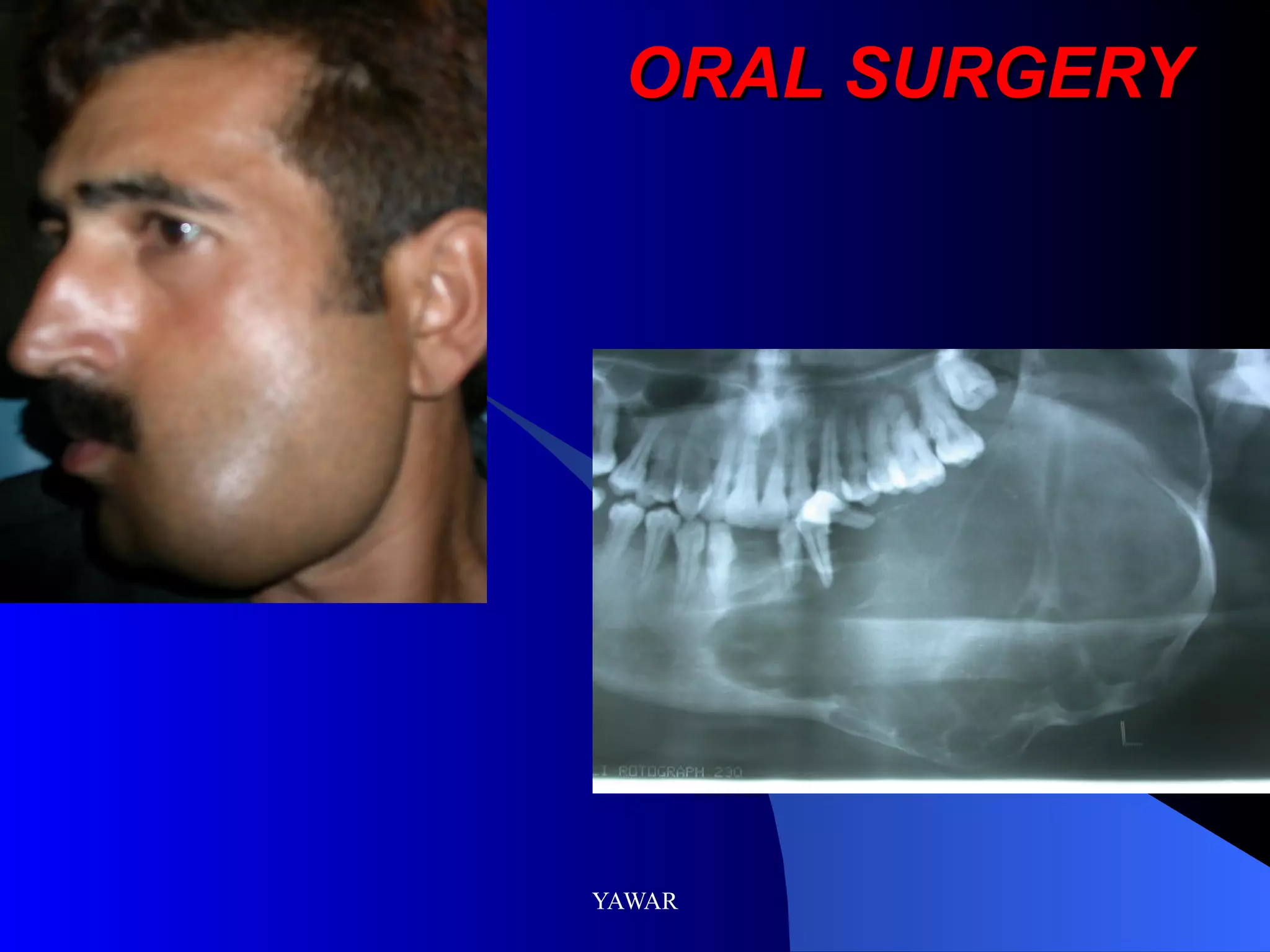 ORAL SURGERY