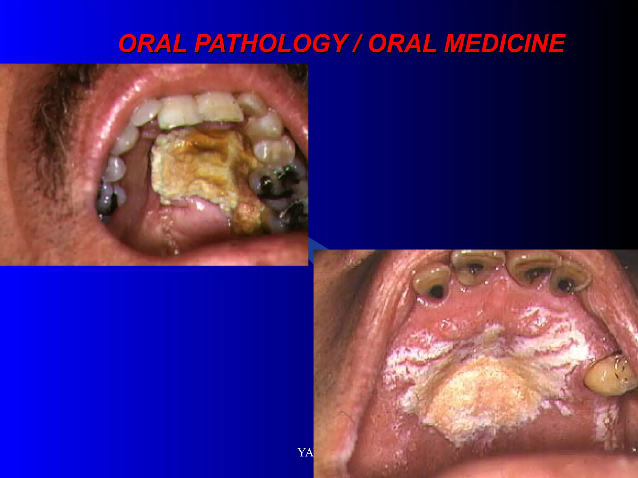 ORAL PATHOLOGY / ORAL MEDICINE