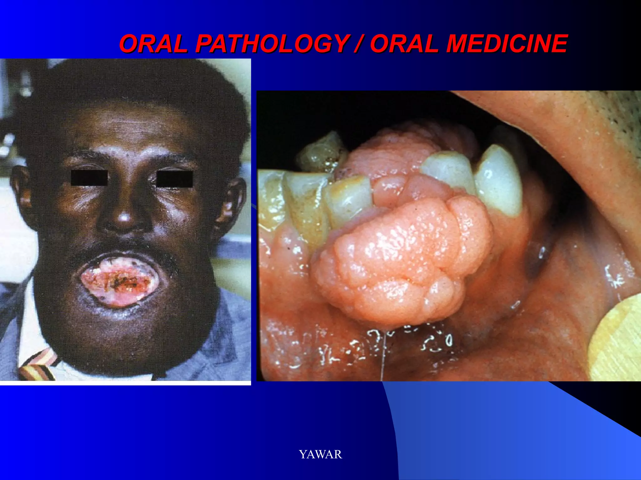 ORAL PATHOLOGY / ORAL MEDICINE