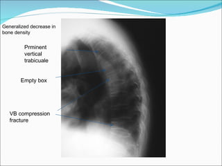 Empty box  Prminent vertical trabicuale VB compression  fracture Generalized decrease in bone density 