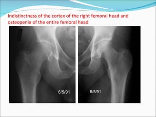 Indistinctness of the cortex of the right femoral head and osteopenia of the entire femoral head 