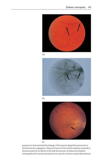 Lecture Notes on Ophthalmology.pdf