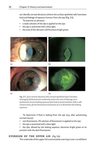 To determine if fluid is leaking from the eye (e.g. after penetrating
corneal injury):
•00non-fluorescent, 2% solution of fluorescein is applied to the eye;
•00the eye is examined with a blue light;
•00the dye, diluted by the leaking aqueous, becomes bright green at its
junction with the dark fluorescein.
EVERSION0OF0THE0UPPER0LID (Fig. 2.6)
The underside of the upper lid is examined by everting it over a small blunt
28 Chapter 2: History and examination
Fig. 2.50(a) A corneal abrasion (the corneal epithelial layer has been
damaged); (b) fluorescein uniformly stains the area of damage; (c) a
perforated cornea leaking aqueous (the leak is protected here with a soft
contact lens); (d) the fluorescein fluoresces as it is diluted by the leaking
aqueous.
(a) (b)
(c) (d)
can identify corneal abrasions (where the surface epithelial cells have been
lost) and leakage of aqueous humour from the eye (Fig. 2.5).
To examine an abrasion:
•00a weak solution of the dye is applied to the eye;
•00the eye is examined with a blue light;
•00the area of the abrasion will fluoresce bright green.
 