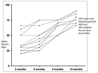 25% fusion rate
Majority satisfied
40% Asx
68% satisfied
No one very
dissatsified
preop
Activity
level
 