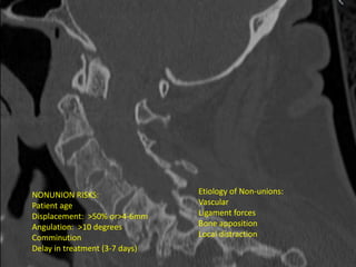 NONUNION RISKS:
Patient age
Displacement: >50% or>4-6mm
Angulation: >10 degrees
Comminution
Delay in treatment (3-7 days)
Etiology of Non-unions:
Vascular
Ligament forces
Bone apposition
Local distraction
 