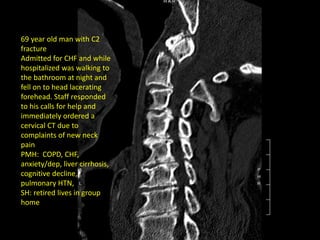 69 year old man with C2
fracture
Admitted for CHF and while
hospitalized was walking to
the bathroom at night and
fell on to head lacerating
forehead. Staff responded
to his calls for help and
immediately ordered a
cervical CT due to
complaints of new neck
pain
PMH: COPD, CHF,
anxiety/dep, liver cirrhosis,
cognitive decline,
pulmonary HTN,
SH: retired lives in group
home
 