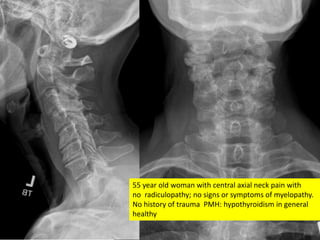55 year old woman with central axial neck pain with
no radiculopathy; no signs or symptoms of myelopathy.
No history of trauma PMH: hypothyroidism in general
healthy
 