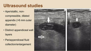 PRINCIPLES OF MANAGEMENT OF DISEASES OF APPENDIX INCLUDING APPENDICITIS ...