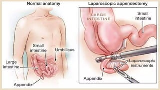 PRINCIPLES OF MANAGEMENT OF DISEASES OF APPENDIX INCLUDING APPENDICITIS ...