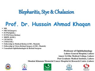Blepharitis, Stye & Chalazion
Prof. Dr. Hussain Ahmad Khaqan
 MD
 FRCS(Glasgow)
 FCPS(Ophth.)
 FCPS(Vitreo Retina)
 MHPE (KMU)
 CICO(UK)
 CMT(UOL)
 Fellowship in Medical Retina (LMU, Munich)
 Fellowship in Vitreo Retinal Surgery (LMU, Munich)
 Consultant Ophthalmologist & Retinal Surgeon
Professor of Ophthalmology
Lahore General Hospital, Lahore
Ameer Ud Din Medical College, Lahore
Post Graduate Medical Institute, Lahore
Shaukat Khanum Memorial Cancer Hospital & Research Centre ,Lahore
 