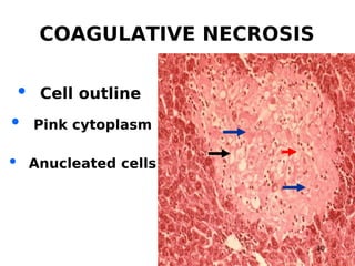 Principles of cell injury and cellular adaptation .ppt Slide 30