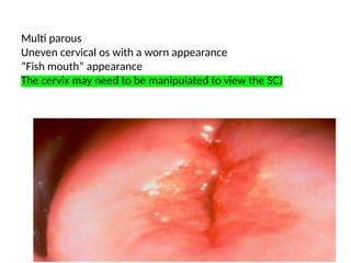 Multi parous
Uneven cervical os with a worn appearance
“Fish mouth” appearance
The cervix may need to be manipulated to view the SCJ
Nulliparous
 