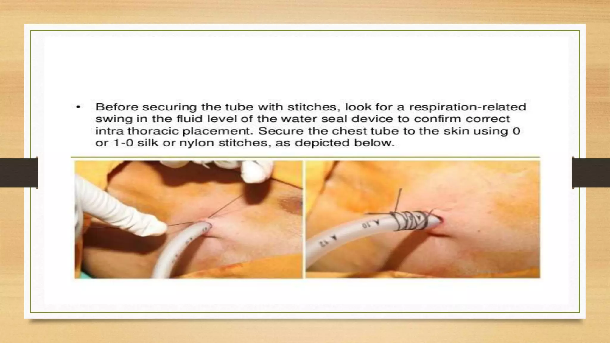 Lecture on chest tube insertion | PPTX