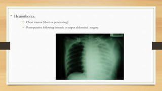 • Hemothorax.
• Chest trauma (blunt or penetrating).
• Postoperative following thoracic or upper abdominal surgery.
 