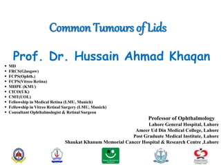 Common Tumours of Lids
Prof. Dr. Hussain Ahmad Khaqan
 MD
 FRCS(Glasgow)
 FCPS(Ophth.)
 FCPS(Vitreo Retina)
 MHPE (KMU)
 CICO(UK)
 CMT(UOL)
 Fellowship in Medical Retina (LMU, Munich)
 Fellowship in Vitreo Retinal Surgery (LMU, Munich)
 Consultant Ophthalmologist & Retinal Surgeon
Professor of Ophthalmology
Lahore General Hospital, Lahore
Ameer Ud Din Medical College, Lahore
Post Graduate Medical Institute, Lahore
Shaukat Khanum Memorial Cancer Hospital & Research Centre ,Lahore
 