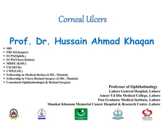 Prof. Dr. Hussain Ahmad Khaqan
 MD
 FRCS(Glasgow)
 FCPS(Ophth.)
 FCPS(Vitreo Retina)
 MHPE (KMU)
 CICO(UK)
 CMT(UOL)
 Fellowship in Medical Retina (LMU, Munich)
 Fellowship in Vitreo Retinal Surgery (LMU, Munich)
 Consultant Ophthalmologist & Retinal Surgeon
Professor of Ophthalmology
Lahore General Hospital, Lahore
Ameer Ud Din Medical College, Lahore
Post Graduate Medical Institute, Lahore
Shaukat Khanum Memorial Cancer Hospital & Research Centre ,Lahore
Corneal Ulcers
 