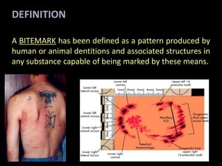 A BITEMARK has been defined as a pattern produced by
human or animal dentitions and associated structures in
any substance capable of being marked by these means.
DEFINITION
 