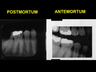 POSTMORTUM ANTEMORTUM
 