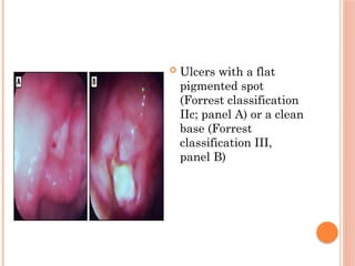 Lecture On acid peptic disorders, upper gastrointestinal bleeding, and ...