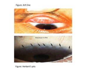 Lecture on Infective Conjunctivitis For 4th Year MBBS Undergraduate ...