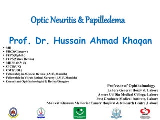 Optic Neuritis & Papilledema
Prof. Dr. Hussain Ahmad Khaqan
 MD
 FRCS(Glasgow)
 FCPS(Ophth.)
 FCPS(Vitreo Retina)
 MHPE (KMU)
 CICO(UK)
 CMT(UOL)
 Fellowship in Medical Retina (LMU, Munich)
 Fellowship in Vitreo Retinal Surgery (LMU, Munich)
 Consultant Ophthalmologist & Retinal Surgeon
Professor of Ophthalmology
Lahore General Hospital, Lahore
Ameer Ud Din Medical College, Lahore
Post Graduate Medical Institute, Lahore
Shaukat Khanum Memorial Cancer Hospital & Research Centre ,Lahore
 