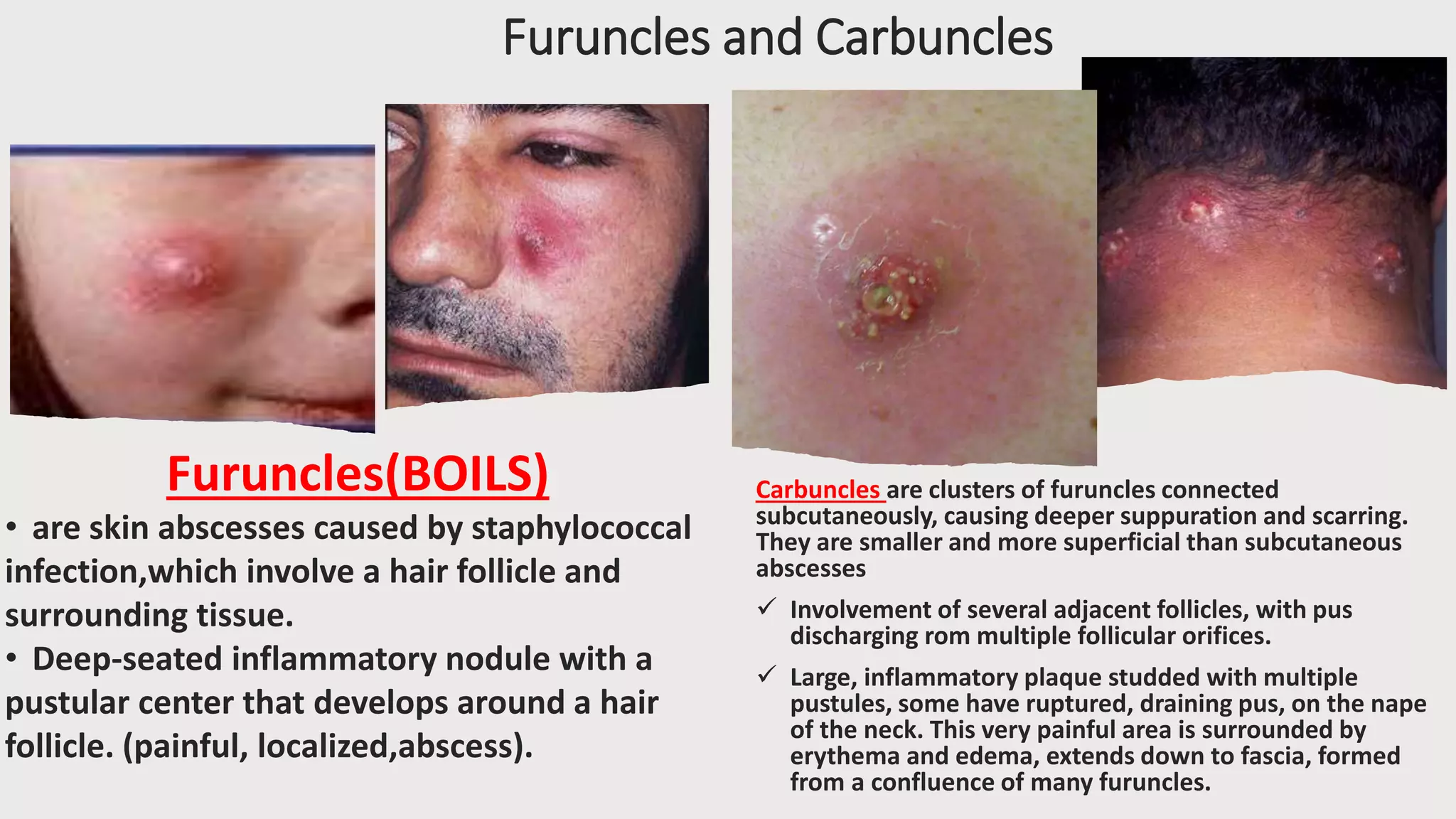 Furuncles and Carbuncles
Carbuncles are clusters of furuncles connected
subcutaneously, causing deeper suppuration and scarring.
They are smaller and more superficial than subcutaneous
abscesses
 Involvement of several adjacent follicles, with pus
discharging rom multiple follicular orifices.
 Large, inflammatory plaque studded with multiple
pustules, some have ruptured, draining pus, on the nape
of the neck. This very painful area is surrounded by
erythema and edema, extends down to fascia, formed
from a confluence of many furuncles.
Furuncles(BOILS)
• are skin abscesses caused by staphylococcal
infection,which involve a hair follicle and
surrounding tissue.
• Deep-seated inflammatory nodule with a
pustular center that develops around a hair
follicle. (painful, localized,abscess).
 