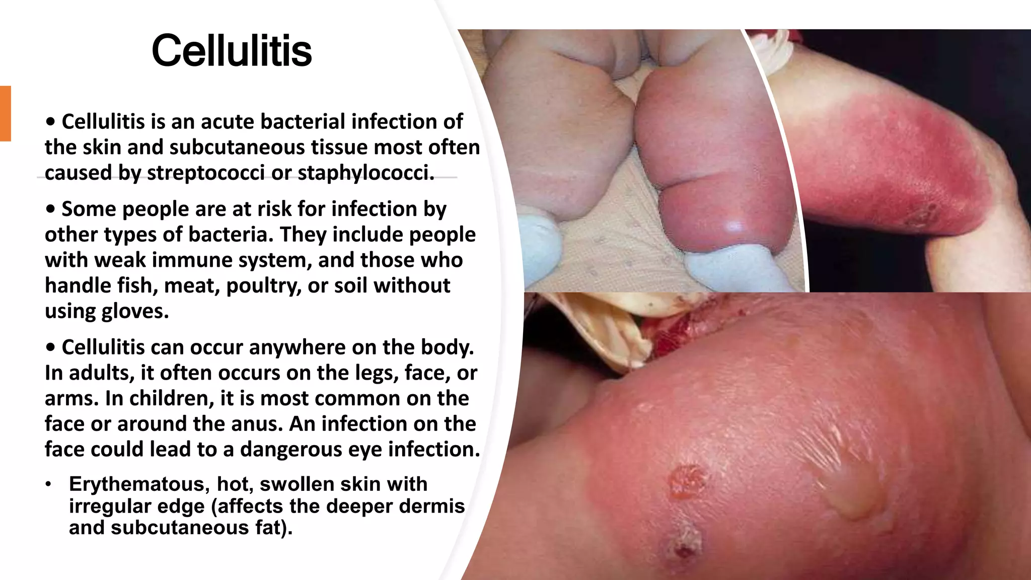 Cellulitis
• Cellulitis is an acute bacterial infection of
the skin and subcutaneous tissue most often
caused by streptococci or staphylococci.
• Some people are at risk for infection by
other types of bacteria. They include people
with weak immune system, and those who
handle fish, meat, poultry, or soil without
using gloves.
• Cellulitis can occur anywhere on the body.
In adults, it often occurs on the legs, face, or
arms. In children, it is most common on the
face or around the anus. An infection on the
face could lead to a dangerous eye infection.
• Erythematous, hot, swollen skin with
irregular edge (affects the deeper dermis
and subcutaneous fat).
 