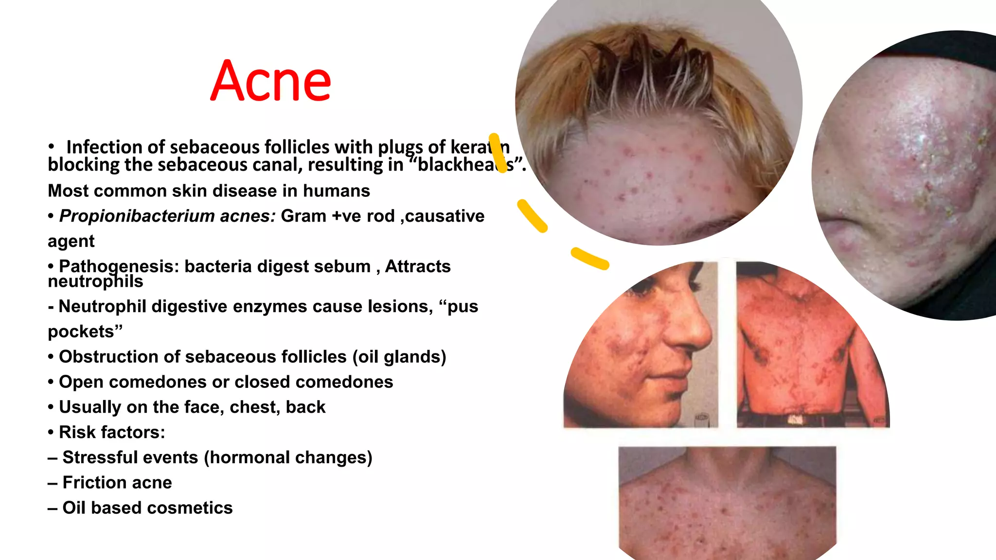 Acne
• Infection of sebaceous follicles with plugs of keratin
blocking the sebaceous canal, resulting in “blackheads”.
Most common skin disease in humans
• Propionibacterium acnes: Gram +ve rod ,causative
agent
• Pathogenesis: bacteria digest sebum , Attracts
neutrophils
- Neutrophil digestive enzymes cause lesions, “pus
pockets”
• Obstruction of sebaceous follicles (oil glands)
• Open comedones or closed comedones
• Usually on the face, chest, back
• Risk factors:
– Stressful events (hormonal changes)
– Friction acne
– Oil based cosmetics
 