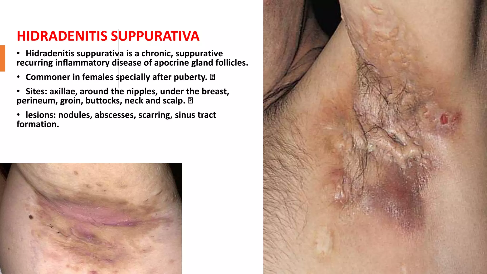 HIDRADENITIS SUPPURATIVA
• Hidradenitis suppurativa is a chronic, suppurative
recurring inflammatory disease of apocrine gland follicles.
• Commoner in females specially after puberty.
• Sites: axillae, around the nipples, under the breast,
perineum, groin, buttocks, neck and scalp.
• lesions: nodules, abscesses, scarring, sinus tract
formation.
 