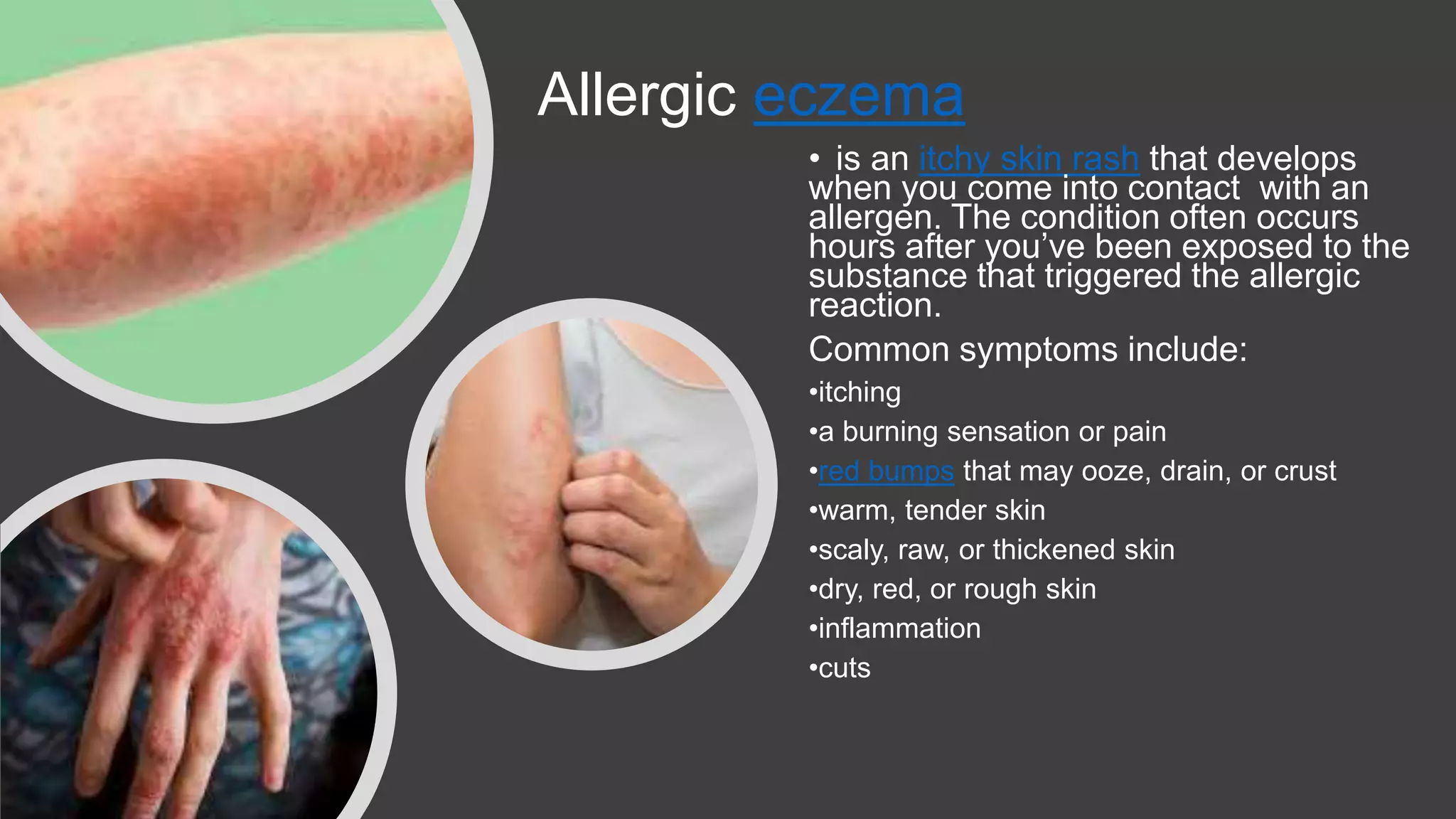 Allergic eczema
• is an itchy skin rash that develops
when you come into contact with an
allergen. The condition often occurs
hours after you’ve been exposed to the
substance that triggered the allergic
reaction.
Common symptoms include:
•itching
•a burning sensation or pain
•red bumps that may ooze, drain, or crust
•warm, tender skin
•scaly, raw, or thickened skin
•dry, red, or rough skin
•inflammation
•cuts
 