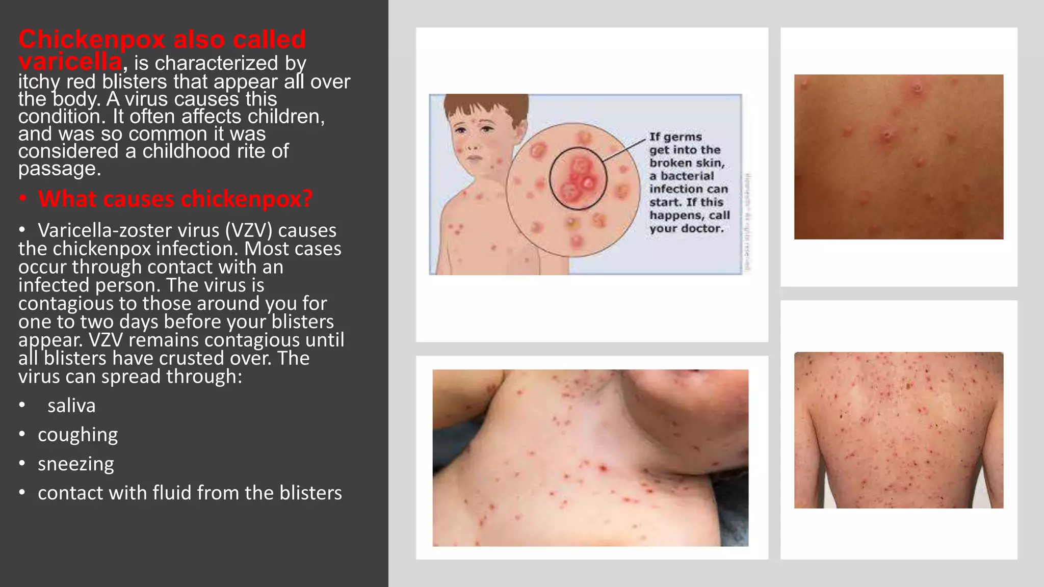 Chickenpox also called
varicella, is characterized by
itchy red blisters that appear all over
the body. A virus causes this
condition. It often affects children,
and was so common it was
considered a childhood rite of
passage.
• What causes chickenpox?
• Varicella-zoster virus (VZV) causes
the chickenpox infection. Most cases
occur through contact with an
infected person. The virus is
contagious to those around you for
one to two days before your blisters
appear. VZV remains contagious until
all blisters have crusted over. The
virus can spread through:
• saliva
• coughing
• sneezing
• contact with fluid from the blisters
 