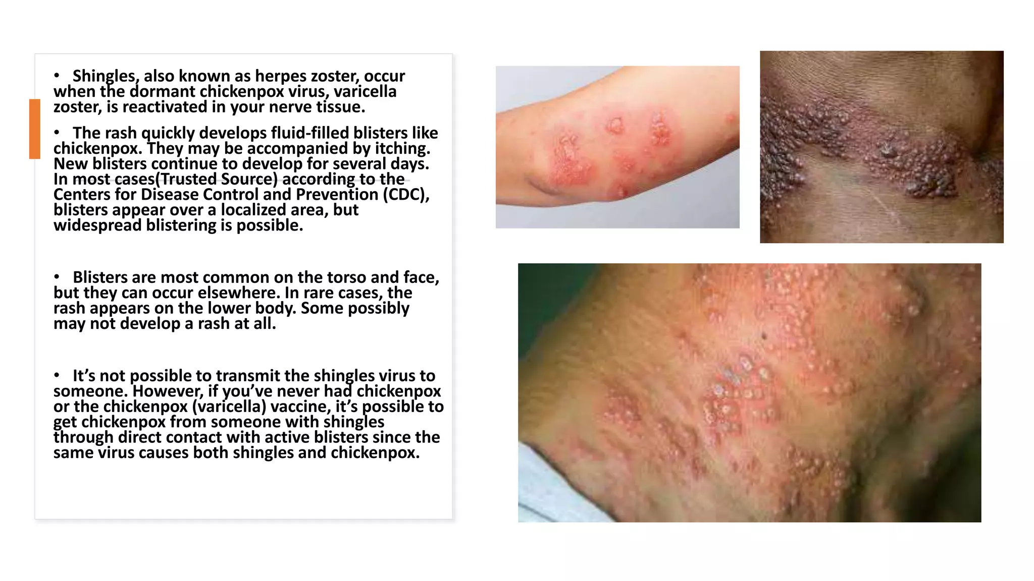 • Shingles, also known as herpes zoster, occur
when the dormant chickenpox virus, varicella
zoster, is reactivated in your nerve tissue.
• The rash quickly develops fluid-filled blisters like
chickenpox. They may be accompanied by itching.
New blisters continue to develop for several days.
In most cases(Trusted Source) according to the
Centers for Disease Control and Prevention (CDC),
blisters appear over a localized area, but
widespread blistering is possible.
• Blisters are most common on the torso and face,
but they can occur elsewhere. In rare cases, the
rash appears on the lower body. Some possibly
may not develop a rash at all.
• It’s not possible to transmit the shingles virus to
someone. However, if you’ve never had chickenpox
or the chickenpox (varicella) vaccine, it’s possible to
get chickenpox from someone with shingles
through direct contact with active blisters since the
same virus causes both shingles and chickenpox.
 