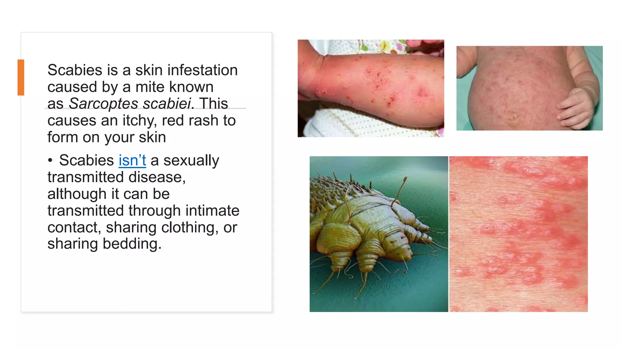Scabies is a skin infestation
caused by a mite known
as Sarcoptes scabiei. This
causes an itchy, red rash to
form on your skin
• Scabies isn’t a sexually
transmitted disease,
although it can be
transmitted through intimate
contact, sharing clothing, or
sharing bedding.
 