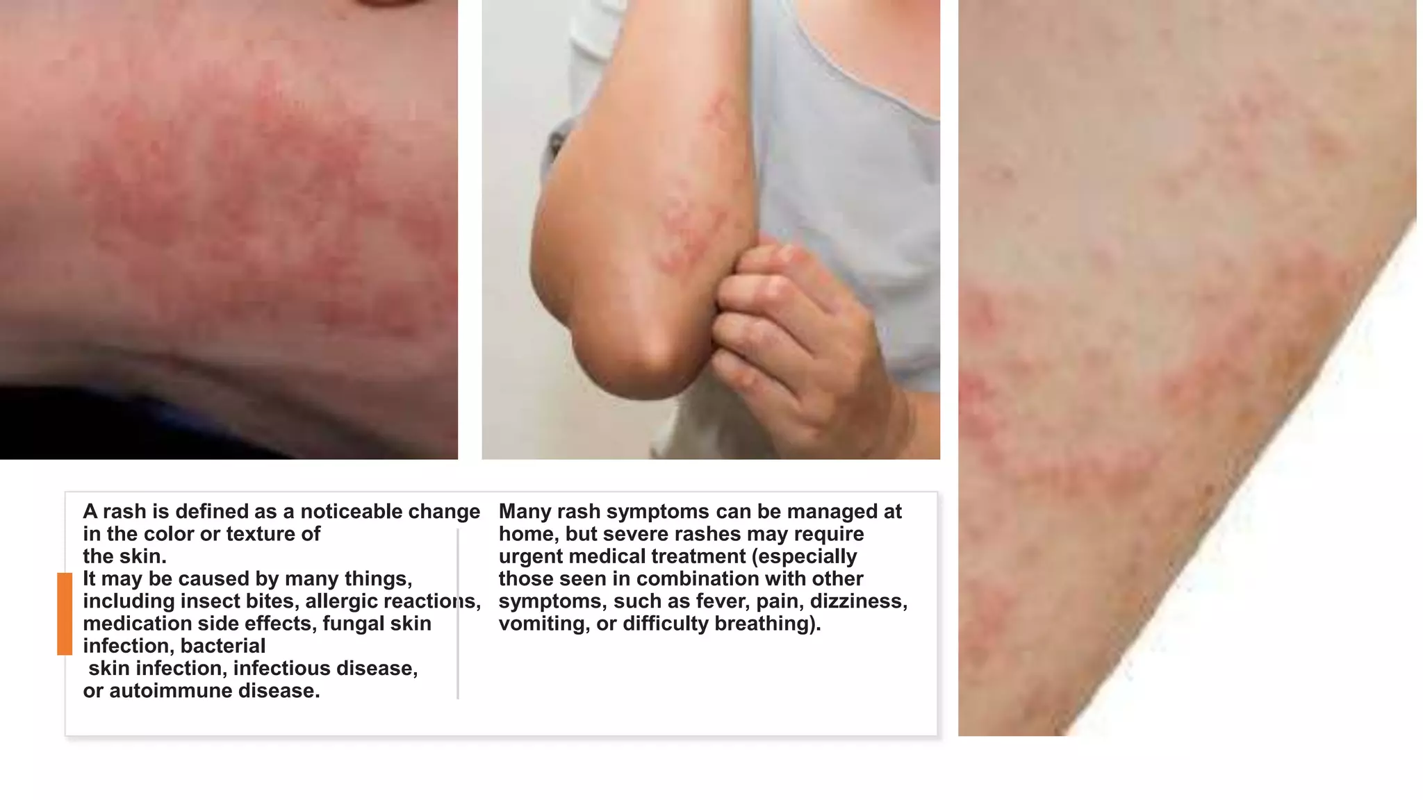 A rash is defined as a noticeable change
in the color or texture of
the skin.
It may be caused by many things,
including insect bites, allergic reactions,
medication side effects, fungal skin
infection, bacterial
skin infection, infectious disease,
or autoimmune disease.
Many rash symptoms can be managed at
home, but severe rashes may require
urgent medical treatment (especially
those seen in combination with other
symptoms, such as fever, pain, dizziness,
vomiting, or difficulty breathing).
 