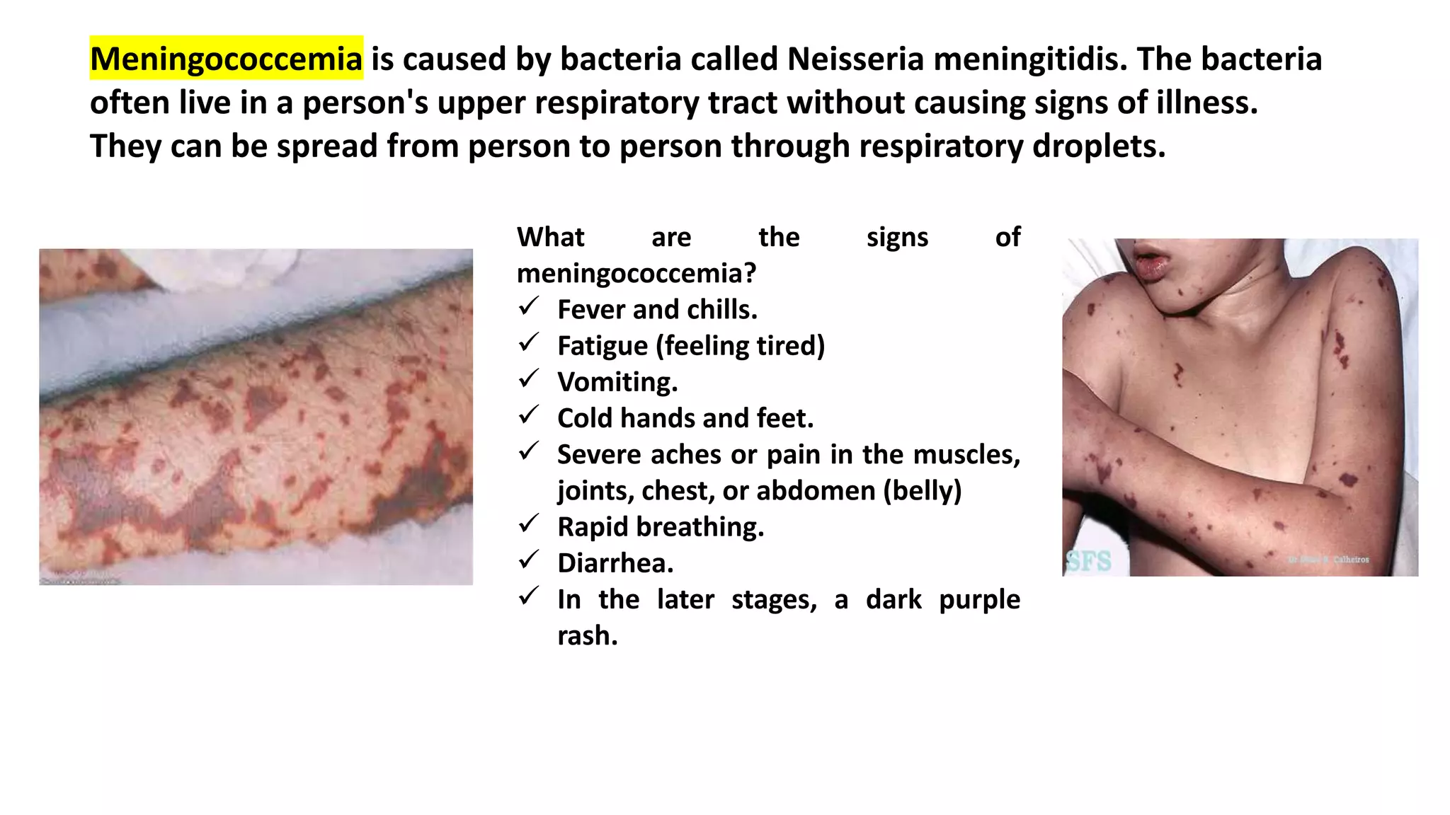 Meningococcemia is caused by bacteria called Neisseria meningitidis. The bacteria
often live in a person's upper respiratory tract without causing signs of illness.
They can be spread from person to person through respiratory droplets.
What are the signs of
meningococcemia?
 Fever and chills.
 Fatigue (feeling tired)
 Vomiting.
 Cold hands and feet.
 Severe aches or pain in the muscles,
joints, chest, or abdomen (belly)
 Rapid breathing.
 Diarrhea.
 In the later stages, a dark purple
rash.
 