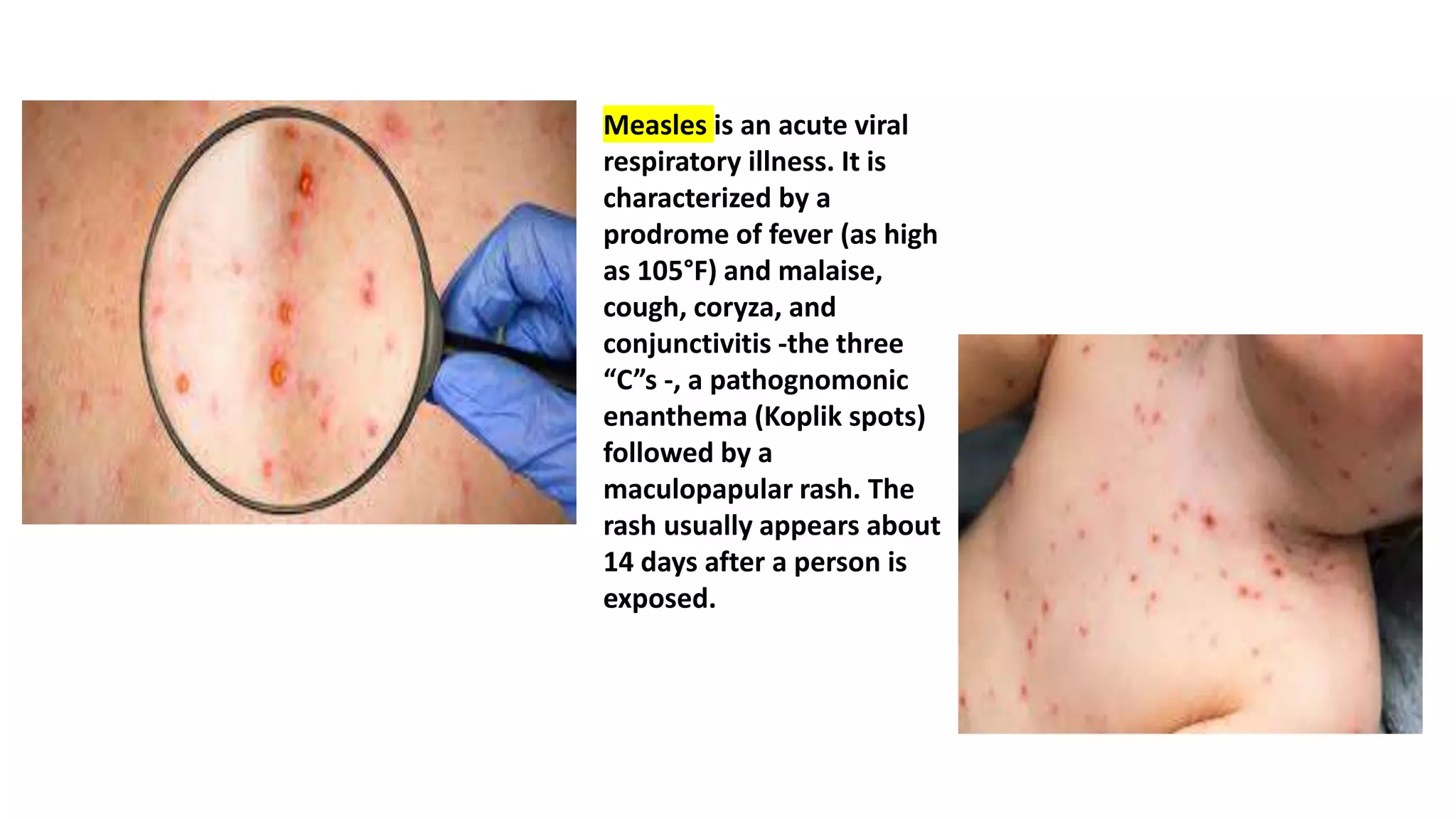 Measles is an acute viral
respiratory illness. It is
characterized by a
prodrome of fever (as high
as 105°F) and malaise,
cough, coryza, and
conjunctivitis -the three
“C”s -, a pathognomonic
enanthema (Koplik spots)
followed by a
maculopapular rash. The
rash usually appears about
14 days after a person is
exposed.
 
