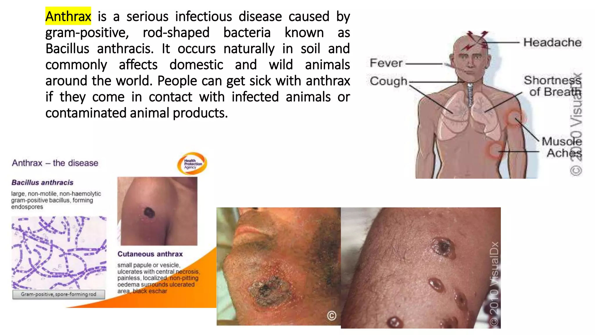Anthrax is a serious infectious disease caused by
gram-positive, rod-shaped bacteria known as
Bacillus anthracis. It occurs naturally in soil and
commonly affects domestic and wild animals
around the world. People can get sick with anthrax
if they come in contact with infected animals or
contaminated animal products.
 
