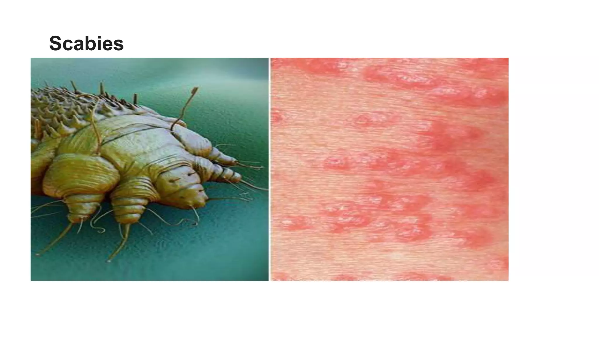 Scabies
 