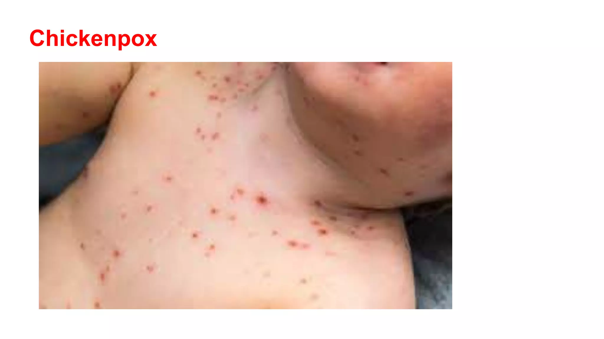Chickenpox
 