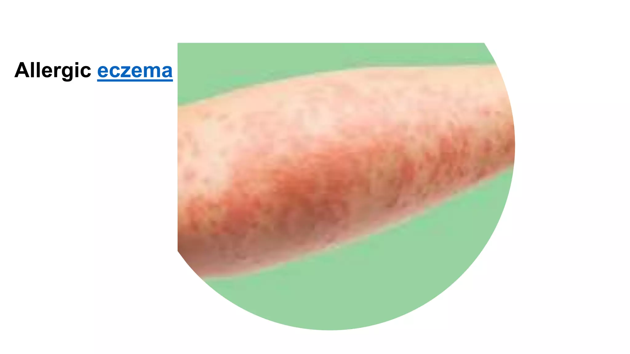 Allergic eczema
 