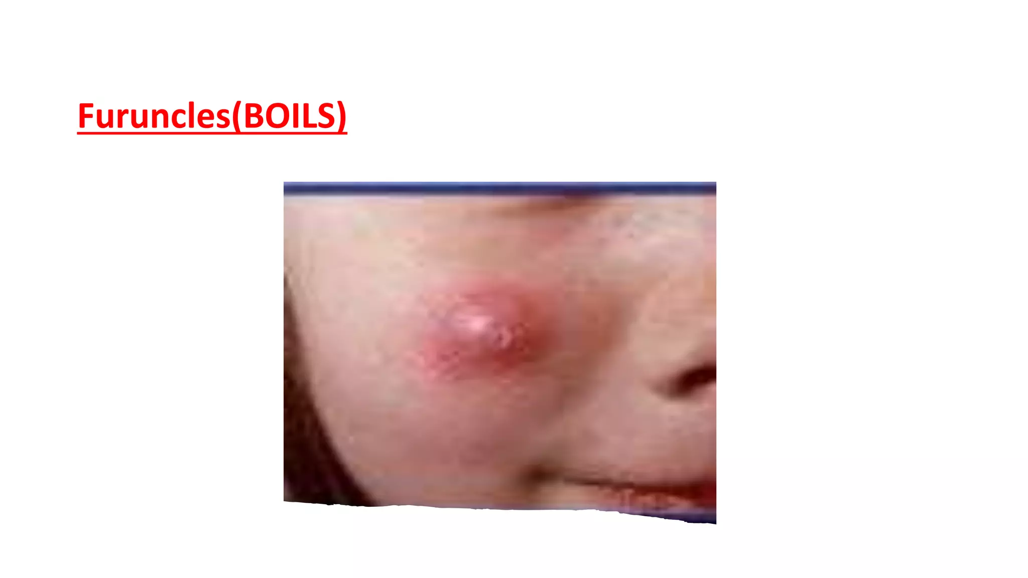 Furuncles(BOILS)
 