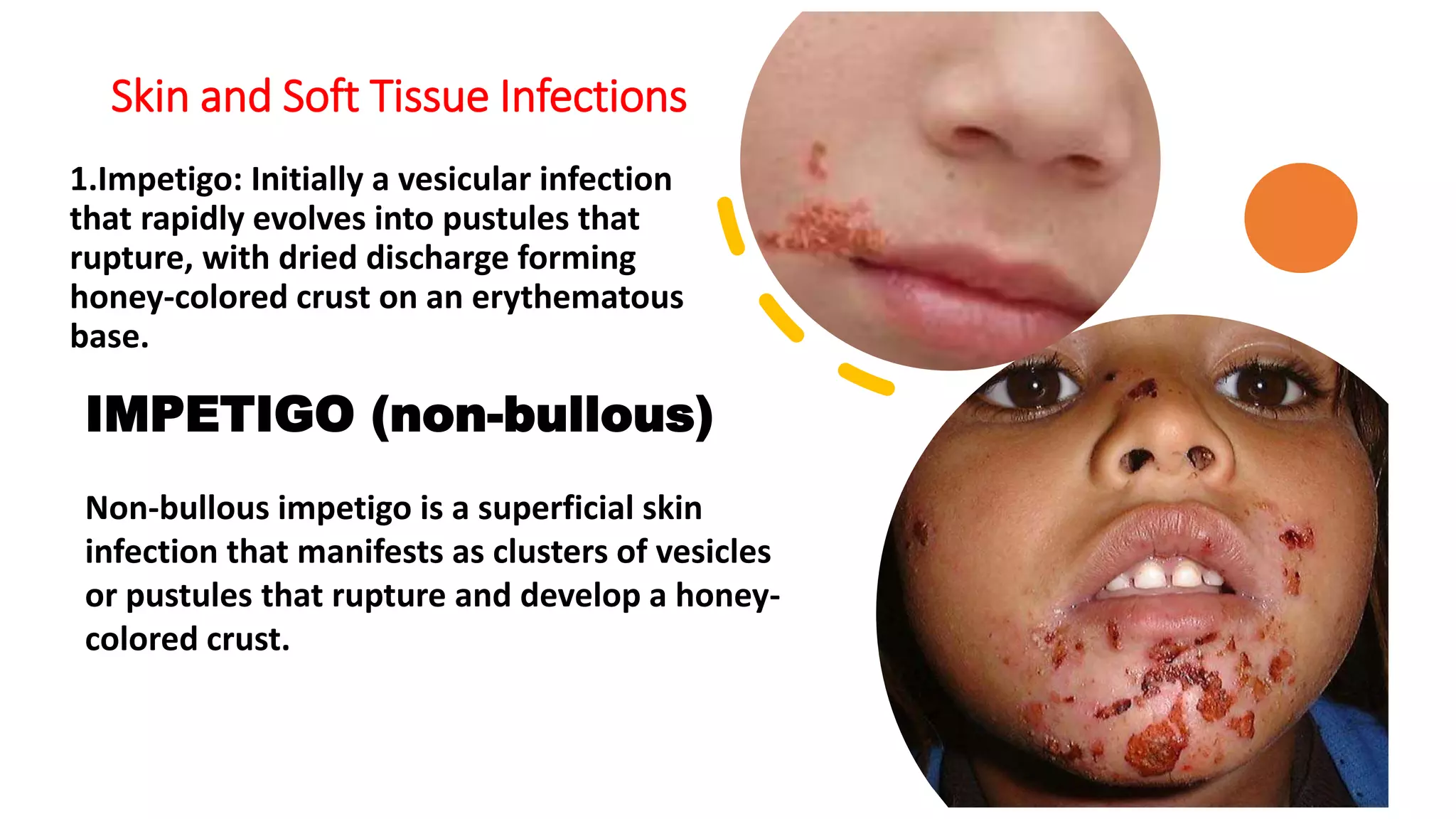 Skin and Soft Tissue Infections
1.Impetigo: Initially a vesicular infection
that rapidly evolves into pustules that
rupture, with dried discharge forming
honey-colored crust on an erythematous
base.
IMPETIGO (non-bullous)
Non-bullous impetigo is a superficial skin
infection that manifests as clusters of vesicles
or pustules that rupture and develop a honey-
colored crust.
 
