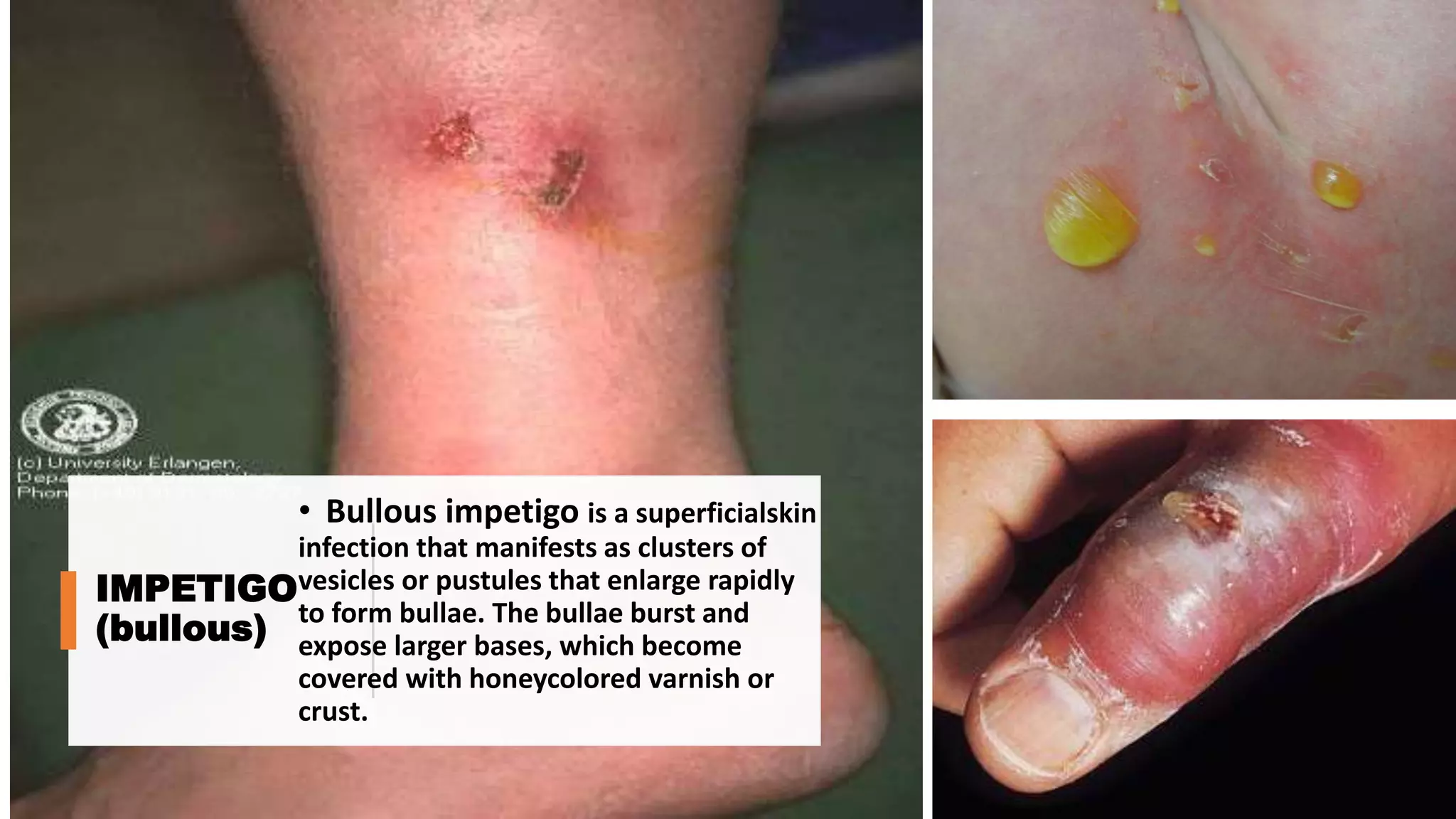 IMPETIGO
(bullous)
• Bullous impetigo is a superficialskin
infection that manifests as clusters of
vesicles or pustules that enlarge rapidly
to form bullae. The bullae burst and
expose larger bases, which become
covered with honeycolored varnish or
crust.
 