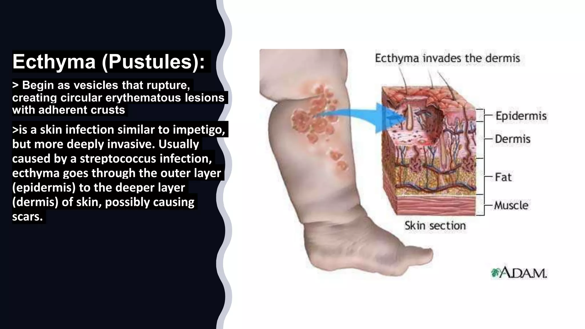 Ecthyma (Pustules):
> Begin as vesicles that rupture,
creating circular erythematous lesions
with adherent crusts
>is a skin infection similar to impetigo,
but more deeply invasive. Usually
caused by a streptococcus infection,
ecthyma goes through the outer layer
(epidermis) to the deeper layer
(dermis) of skin, possibly causing
scars.
 