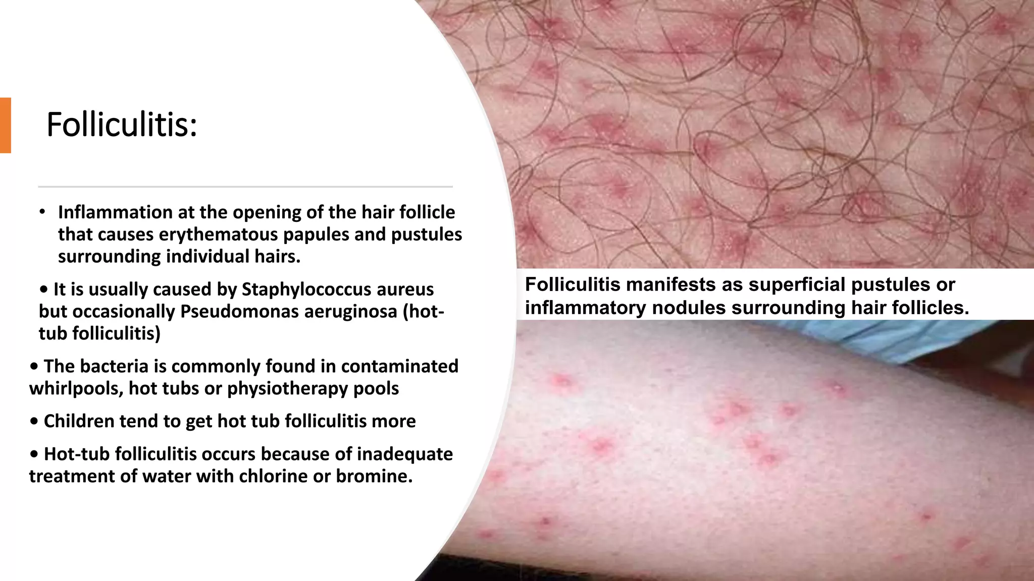 Folliculitis:
• Inflammation at the opening of the hair follicle
that causes erythematous papules and pustules
surrounding individual hairs.
• It is usually caused by Staphylococcus aureus
but occasionally Pseudomonas aeruginosa (hot-
tub folliculitis)
• The bacteria is commonly found in contaminated
whirlpools, hot tubs or physiotherapy pools
• Children tend to get hot tub folliculitis more
• Hot-tub folliculitis occurs because of inadequate
treatment of water with chlorine or bromine.
Folliculitis manifests as superficial pustules or
inflammatory nodules surrounding hair follicles.
 