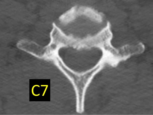 Revision Posterior Cervical Laminoplasty Revision Posterior Cervical Laminoplasty