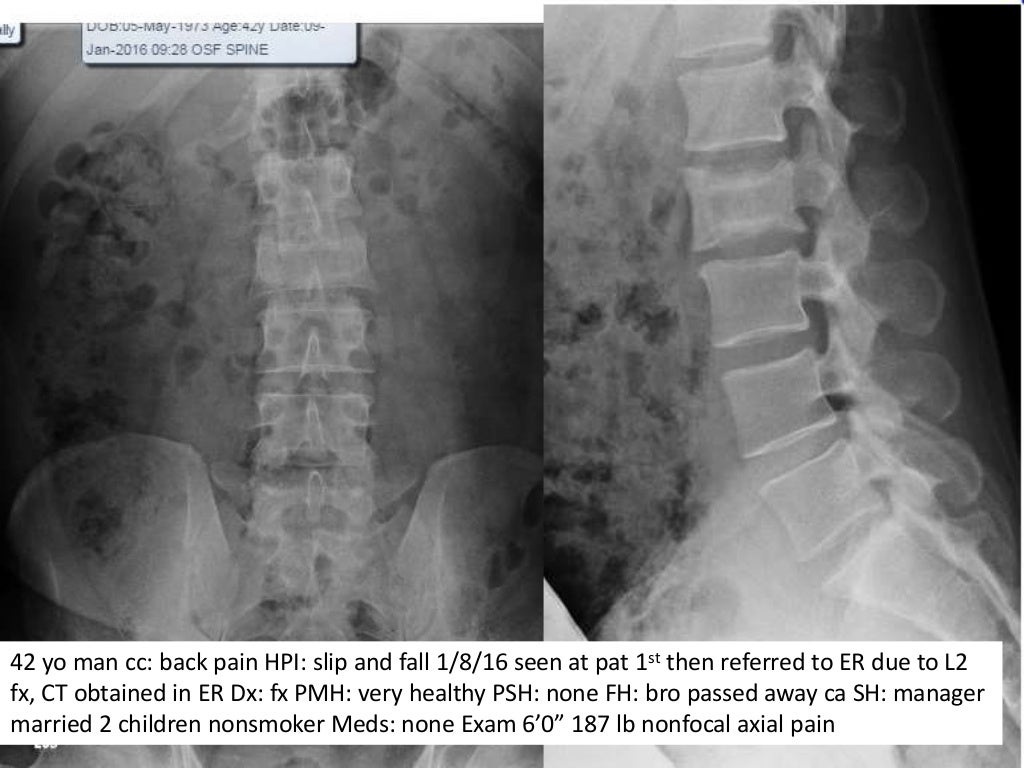 Lecture paget’s disease of the spine