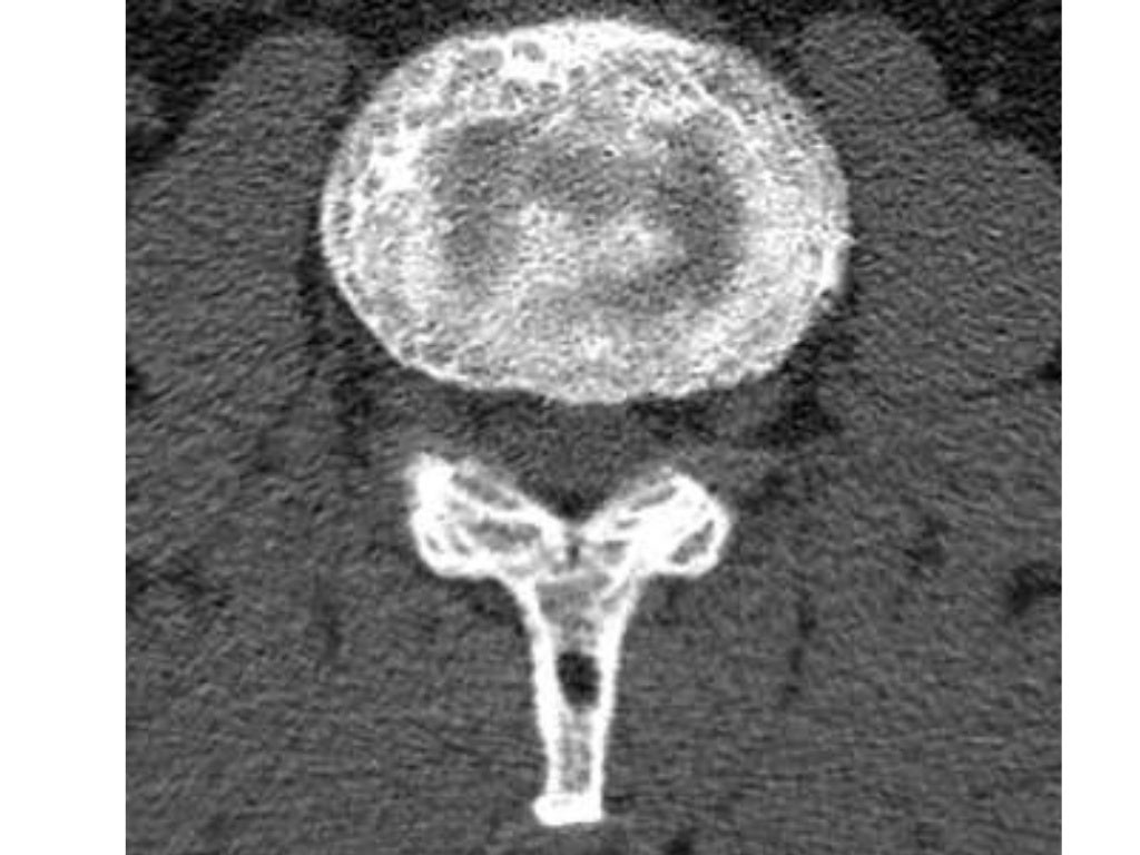 Lecture paget’s disease of the spine
