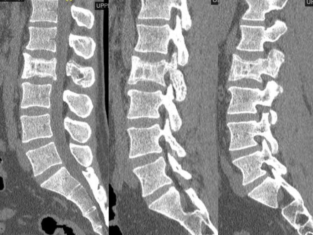 Lecture paget’s disease of the spine